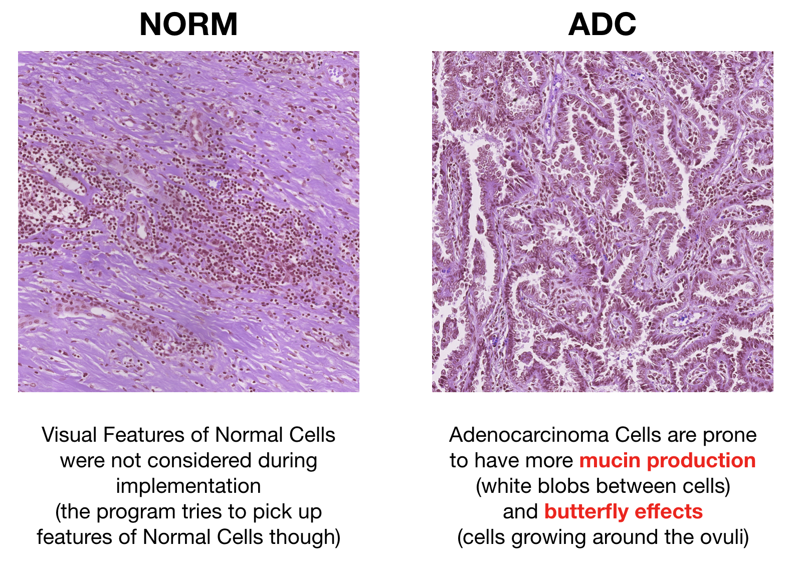 lung cancer histology