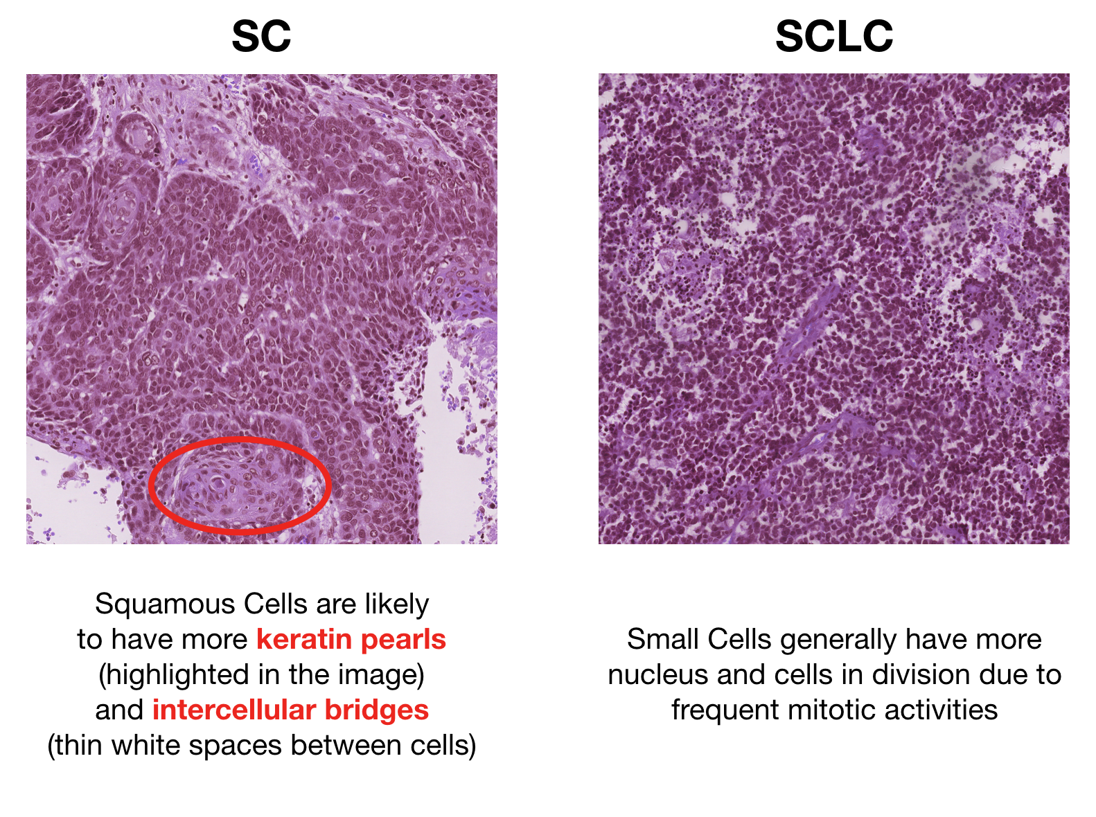 lung cancer histology